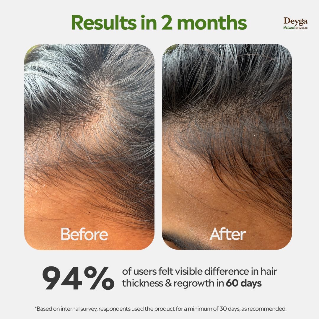 Deyga Hair Growth Oil | Promotes Hair Growth | Reduces Hairfall | Repairs Damaged Hair | Infused with Hibiscus, Rosemary & Grapeseed Oil (100ml Hair Growth Oil) | Suits Men and Women